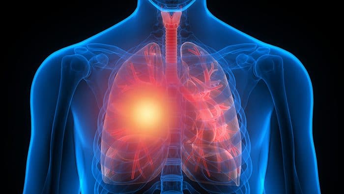 Ask the Expert: How Inflammation Relates to Cancer 3 14 ask expert story01